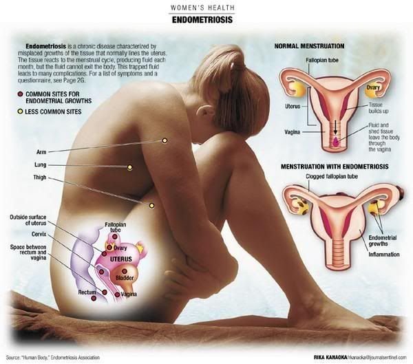petefészekrák vagy endometriózis)